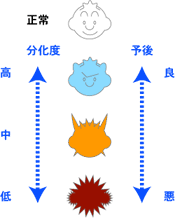 大腸がん　組織型と予後