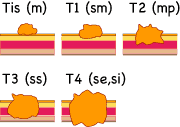 TNM分類　T