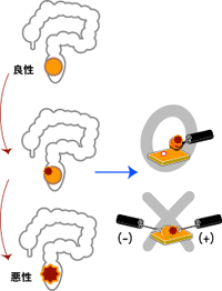 大腸ポリープと胃ポリープの違い