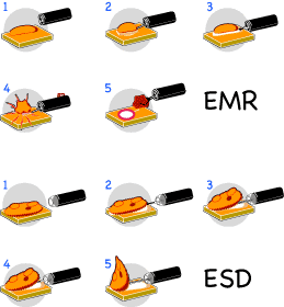 EMR ESD