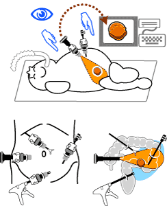 腹腔鏡補助下大腸切除術