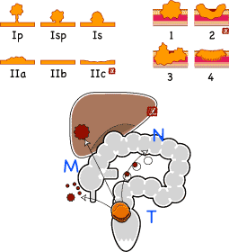 大腸癌の分類 まとめ イラストでみる大腸肛門病