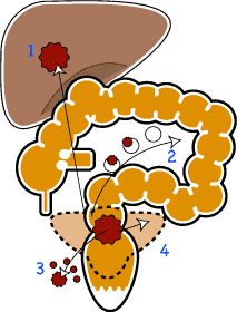 大腸癌　進展と転移
