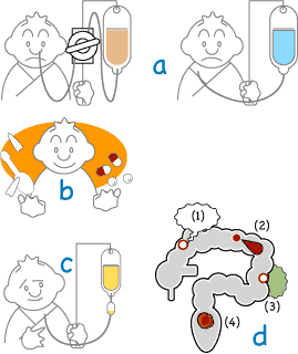 クローン病の治療法