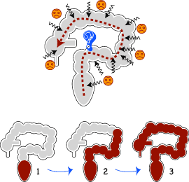 潰瘍性大腸炎 診断 まとめ イラストでみる大腸肛門病