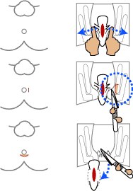 裂肛の治療