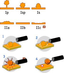 内視鏡下大腸ポリープ切除