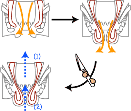 直腸脱　手術